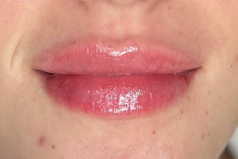 Lip Filler Before & After Gallery - Patient 216582 - Image 2