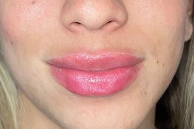Lip Filler Before & After Gallery - Patient 410936 - Image 2