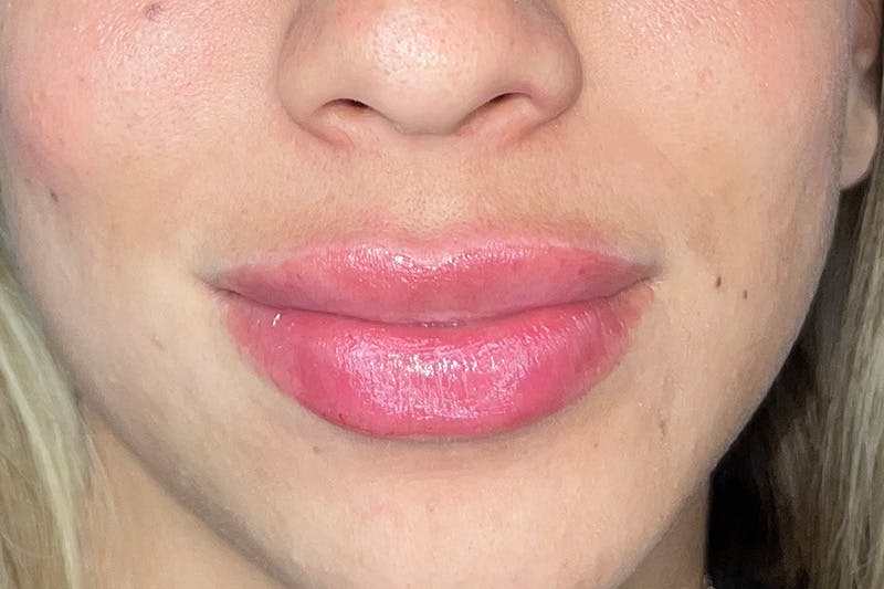 Lip Filler Before & After Gallery - Patient 410936 - Image 2