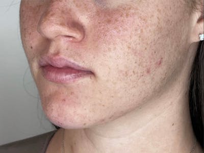 Facial Filler Before & After Gallery - Patient 331601 - Image 2