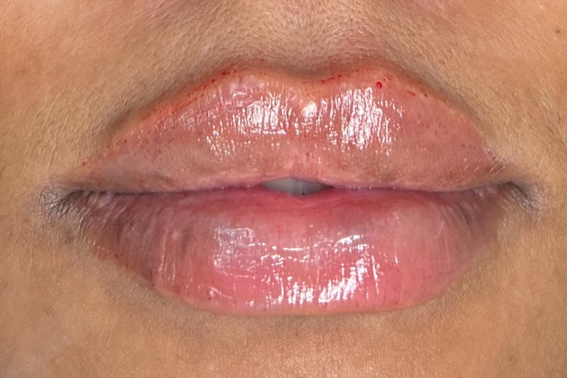 Lip Filler Before & After Gallery - Patient 313106 - Image 2