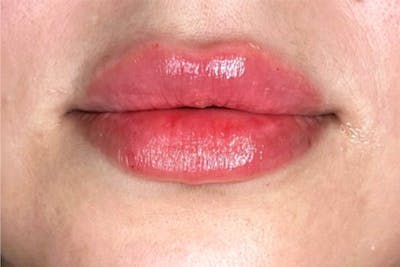 Lip Filler Before & After Gallery - Patient 246837 - Image 2