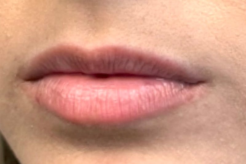 Lip Filler Before & After Gallery - Patient 118787 - Image 3