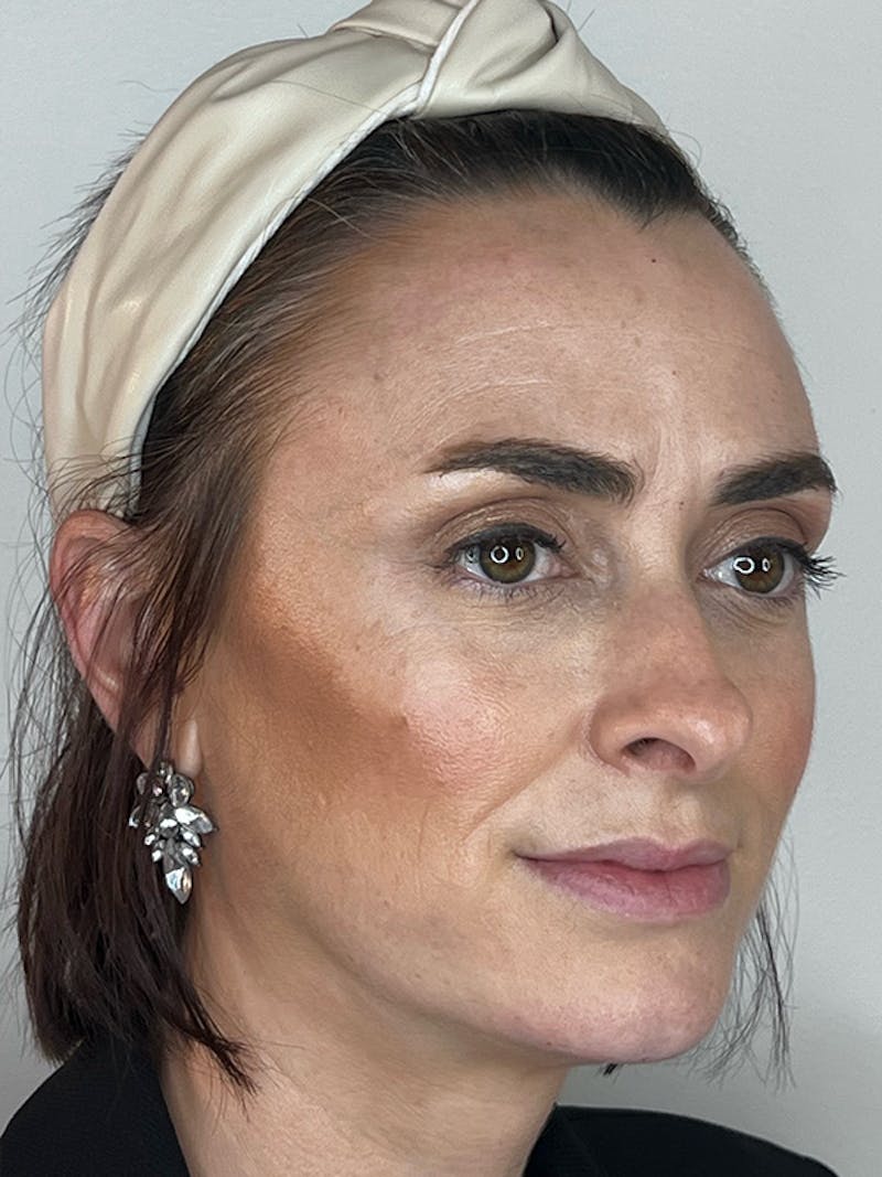 Facial Filler Before & After Gallery - Patient 370702 - Image 4