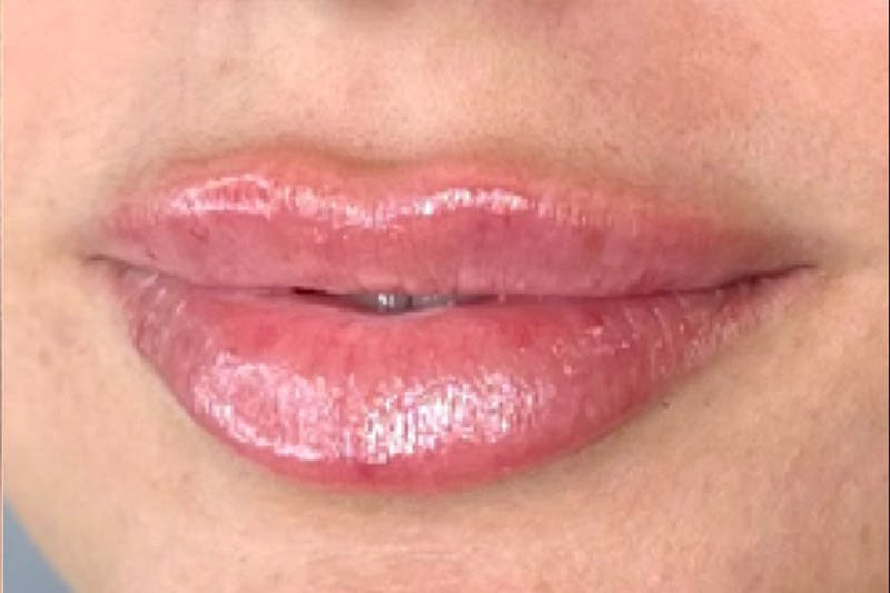Lip Filler Before & After Gallery - Patient 118787 - Image 4