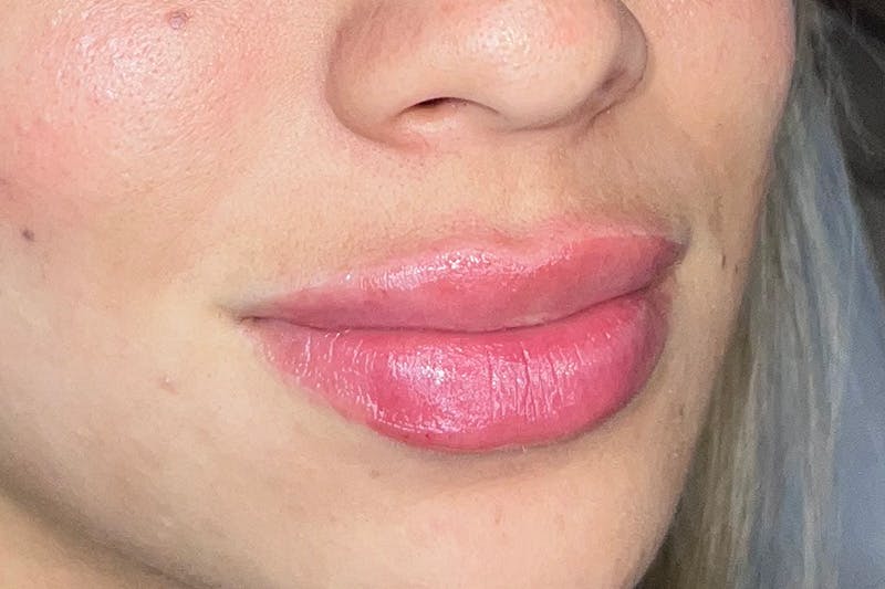Lip Filler Before & After Gallery - Patient 410936 - Image 4