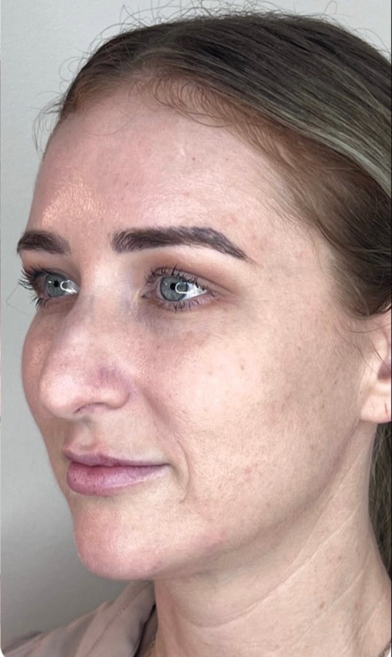 Facial Filler Before & After Gallery - Patient 602048 - Image 4