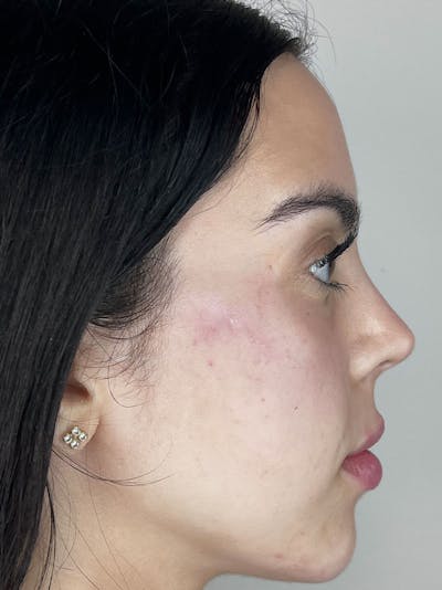 Facial Filler Before & After Gallery - Patient 297656 - Image 2