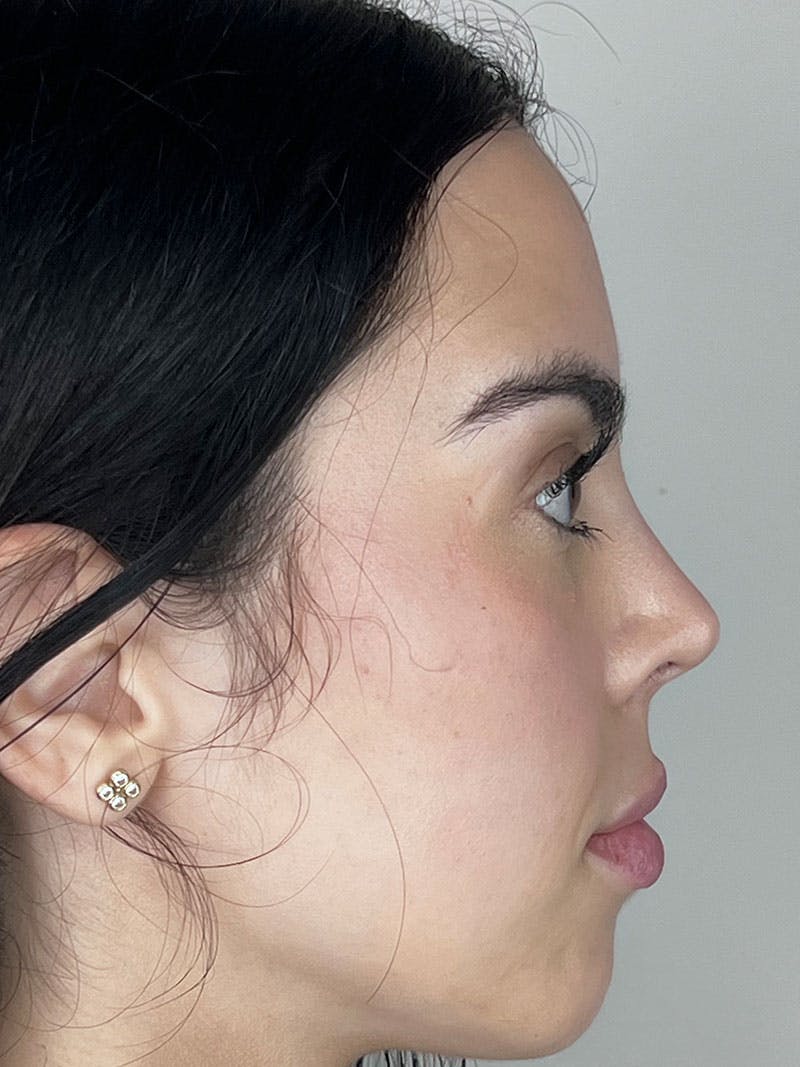 Facial Filler Before & After Gallery - Patient 297656 - Image 1