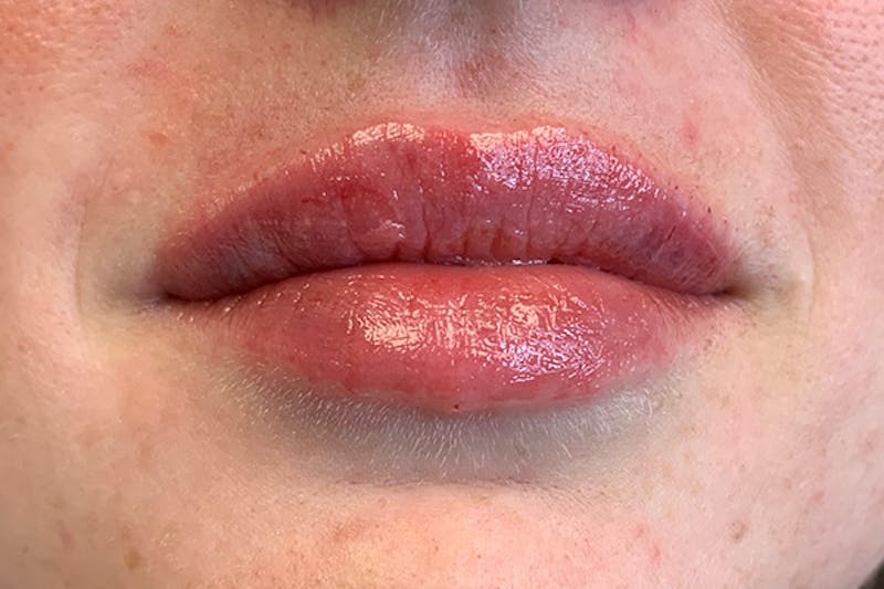Lip Filler Before & After Gallery - Patient 170042 - Image 2