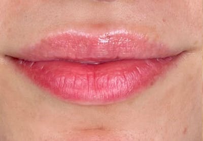 Lip Filler Before & After Gallery - Patient 780844 - Image 1
