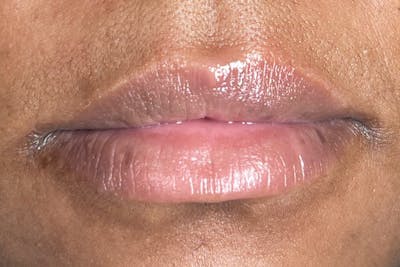 Lip Filler Before & After Gallery - Patient 313106 - Image 1