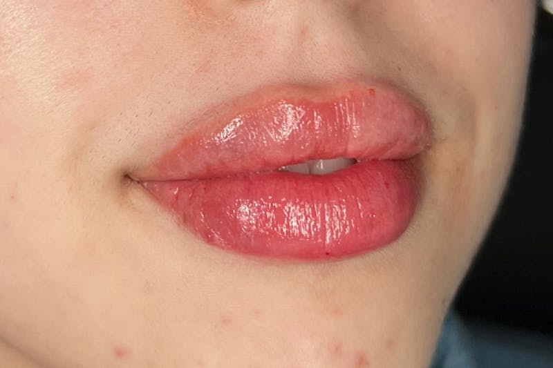 Lip Filler Before & After Gallery - Patient 274165 - Image 4