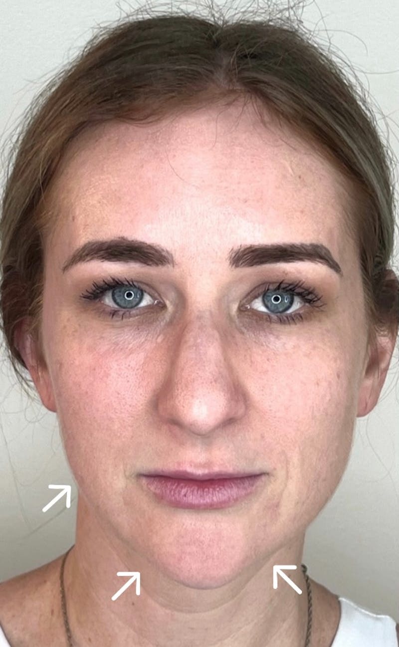 Facial Filler Before & After Gallery - Patient 602048 - Image 1