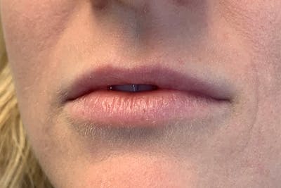 Lip Filler Before & After Gallery - Patient 323060 - Image 1
