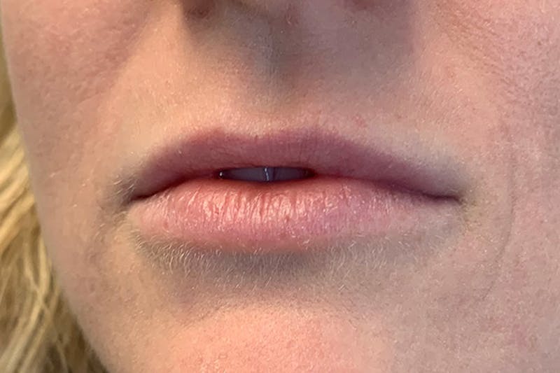 Lip Filler Before & After Gallery - Patient 323060 - Image 1