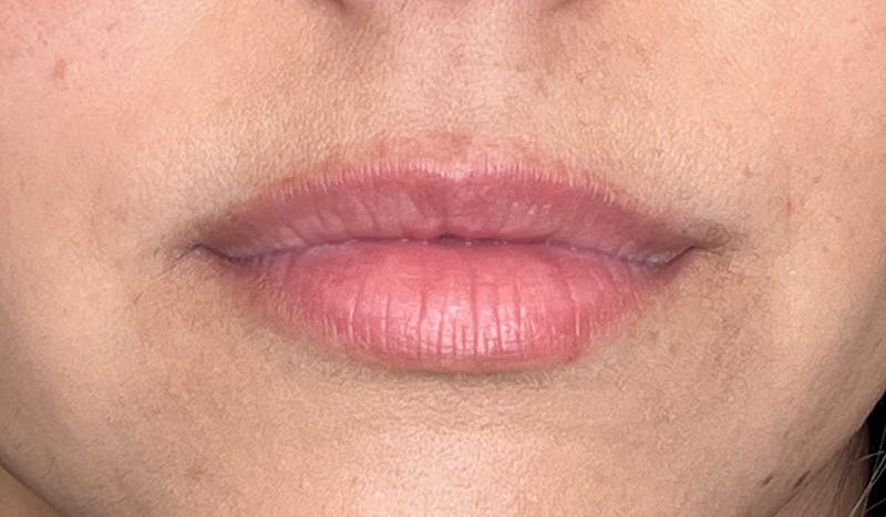 Lip Filler Before & After Gallery - Patient 425516 - Image 3