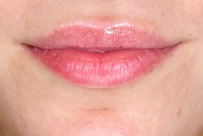 Lip Filler Before & After Gallery - Patient 153151 - Image 1