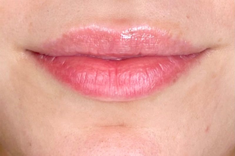 Lip Filler Before & After Gallery - Patient 153151 - Image 1