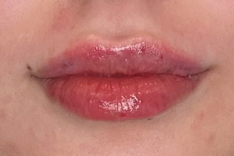 Lip Filler Before & After Gallery - Patient 360054 - Image 2