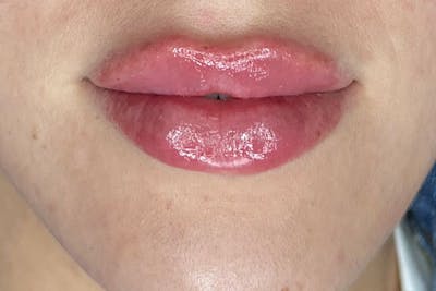 Lip Filler Before & After Gallery - Patient 148148 - Image 2