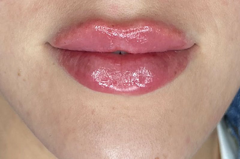 Lip Filler Before & After Gallery - Patient 148148 - Image 2