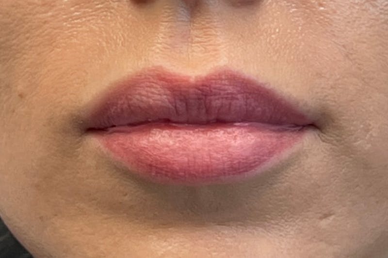 Lip Filler Before & After Gallery - Patient 364057 - Image 5