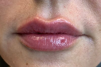 Lip Filler Before & After Gallery - Patient 334450 - Image 2