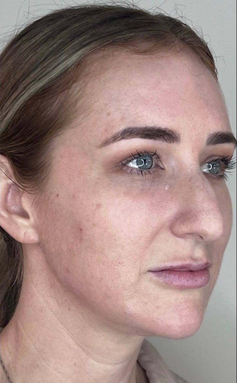 Facial Filler Before & After Gallery - Patient 602048 - Image 6