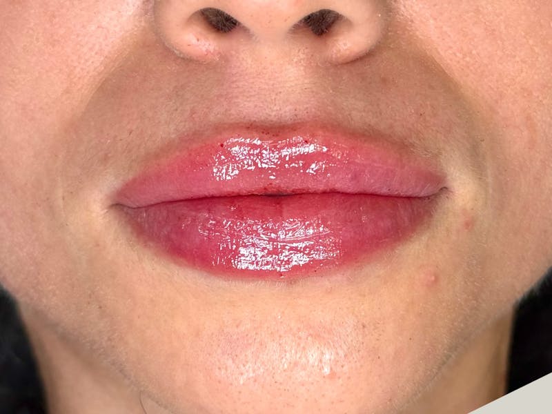Lip Filler Before & After Gallery - Patient 148542 - Image 2