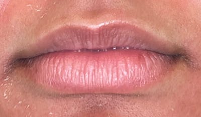 Lip Filler Before & After Gallery - Patient 920619 - Image 1