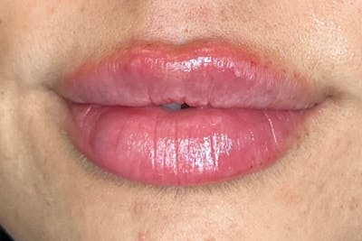 Lip Filler Before & After Gallery - Patient 298428 - Image 2
