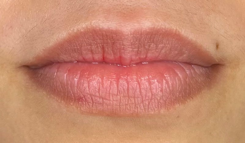 Lip Filler Before & After Gallery - Patient 418100 - Image 1