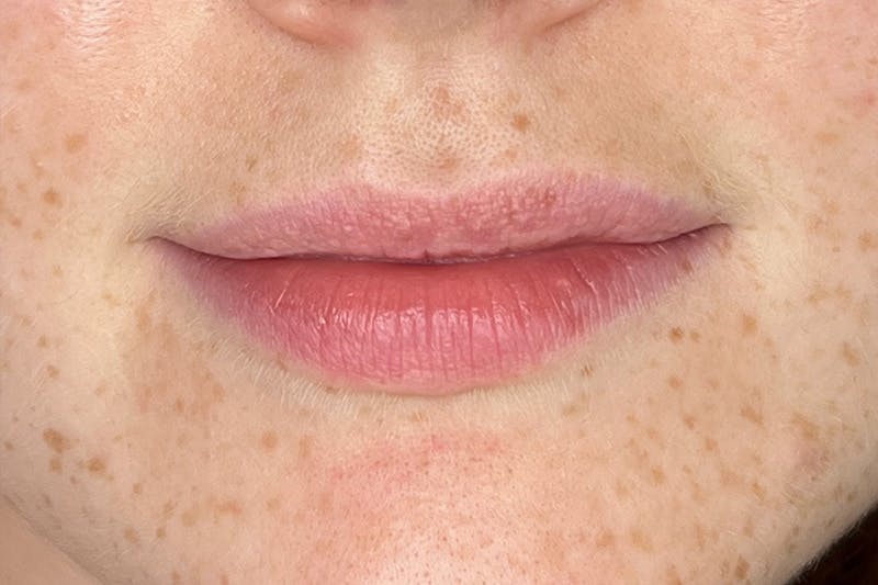 Lip Filler Before & After Gallery - Patient 229260 - Image 1