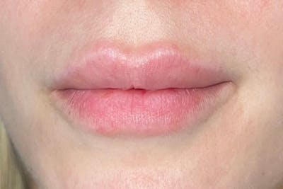 Lip Filler Before & After Gallery - Patient 383343 - Image 1