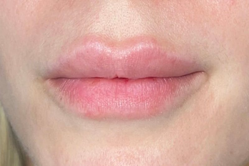 Lip Filler Before & After Gallery - Patient 383343 - Image 1