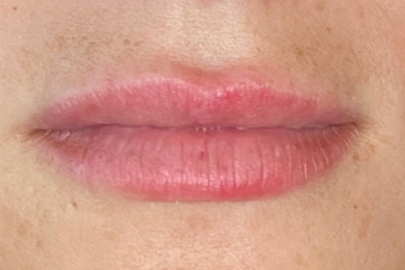 Lip Filler Before & After Gallery - Patient 245062 - Image 1