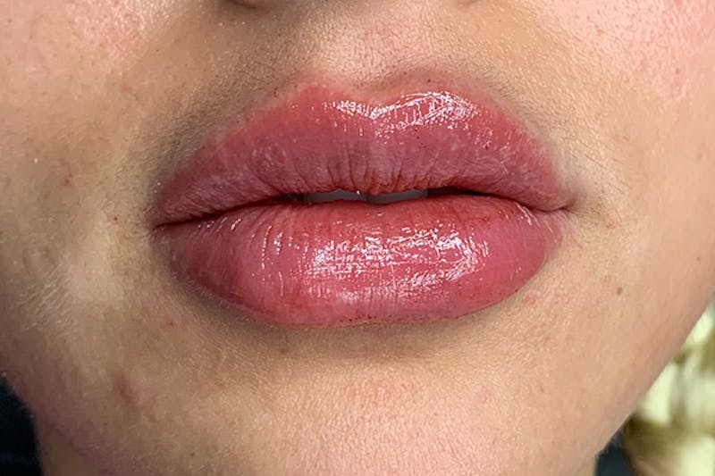 Lip Filler Before & After Gallery - Patient 124181 - Image 2
