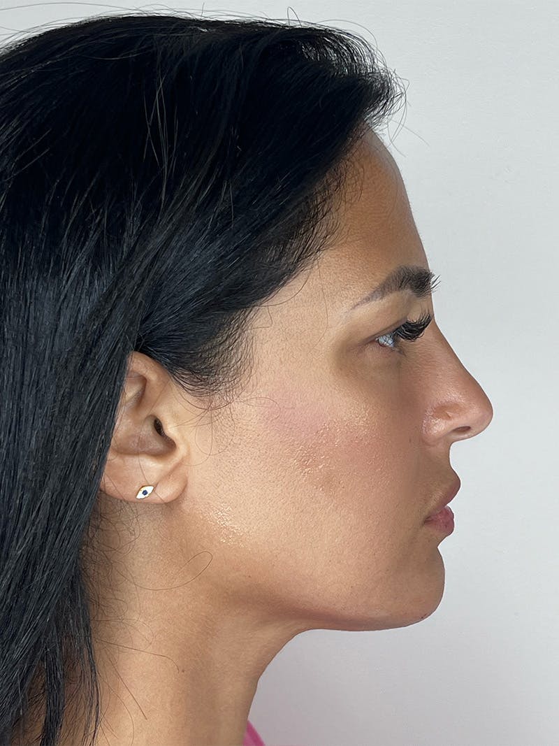 Facial Filler Before & After Gallery - Patient 141862 - Image 2