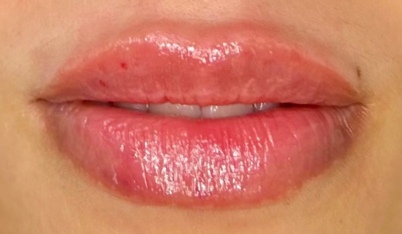 Lip Filler Before & After Gallery - Patient 418100 - Image 2