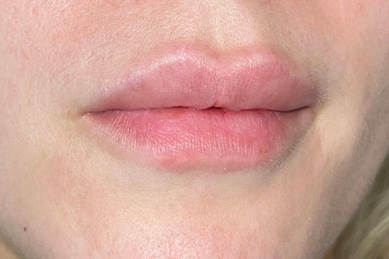 Lip Filler Before & After Gallery - Patient 383343 - Image 3