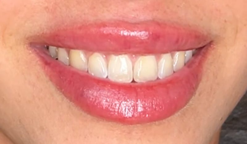Lip Filler Before & After Gallery - Patient 425516 - Image 2