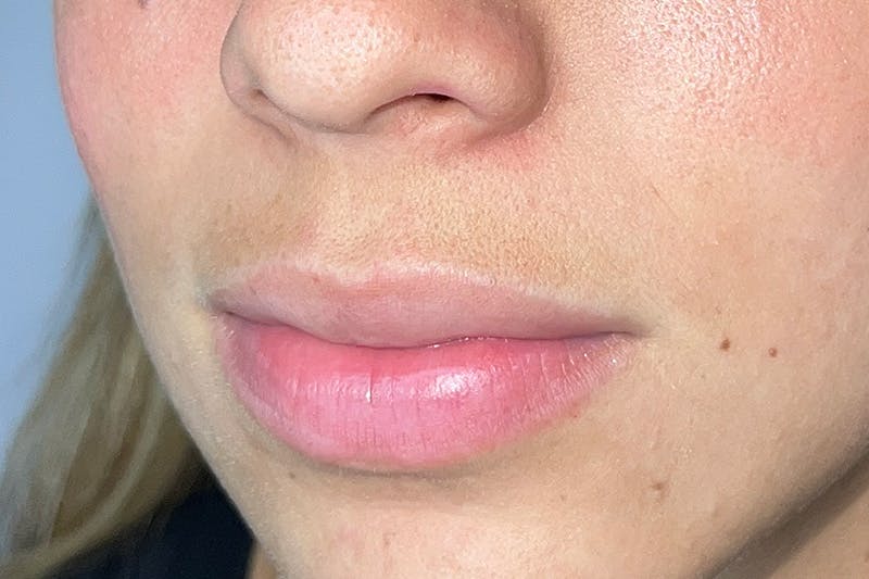 Lip Filler Before & After Gallery - Patient 410936 - Image 5