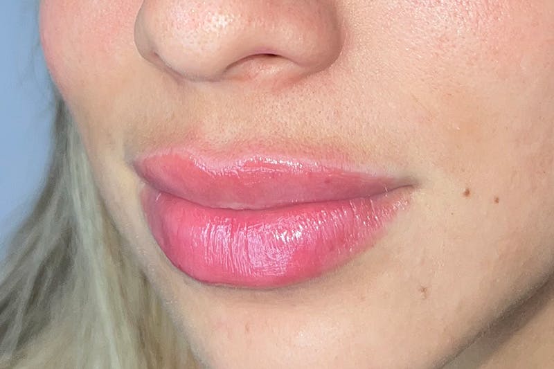 Lip Filler Before & After Gallery - Patient 410936 - Image 6