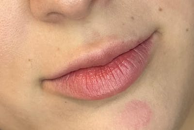 Lip Filler Before & After Gallery - Patient 312157 - Image 1