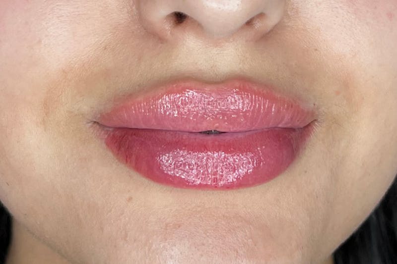 Lip Filler Before & After Gallery - Patient 117693 - Image 2