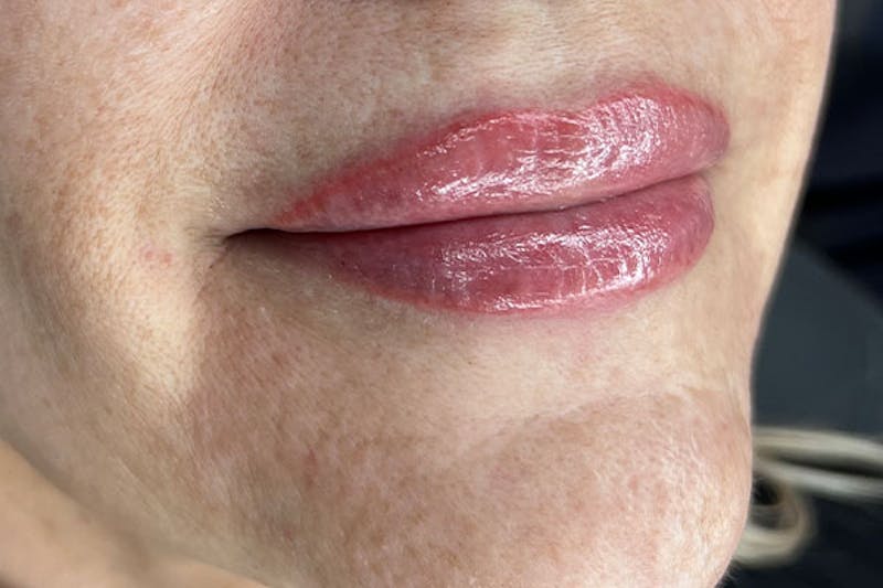 Lip Filler Before & After Gallery - Patient 406528 - Image 4