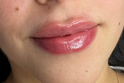 Lip Filler Before & After Gallery - Patient 240077 - Image 2