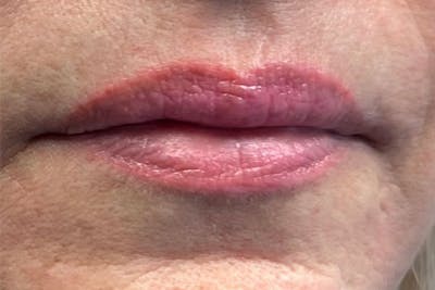 Lip Filler Before & After Gallery - Patient 406528 - Image 1
