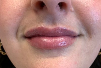 Lip Filler Before & After Gallery - Patient 220816 - Image 2